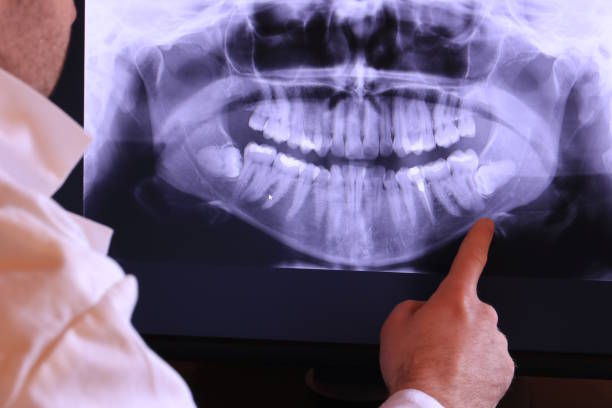 Best Emergency Wisdom Tooth Extraction in Hillsboro, ND